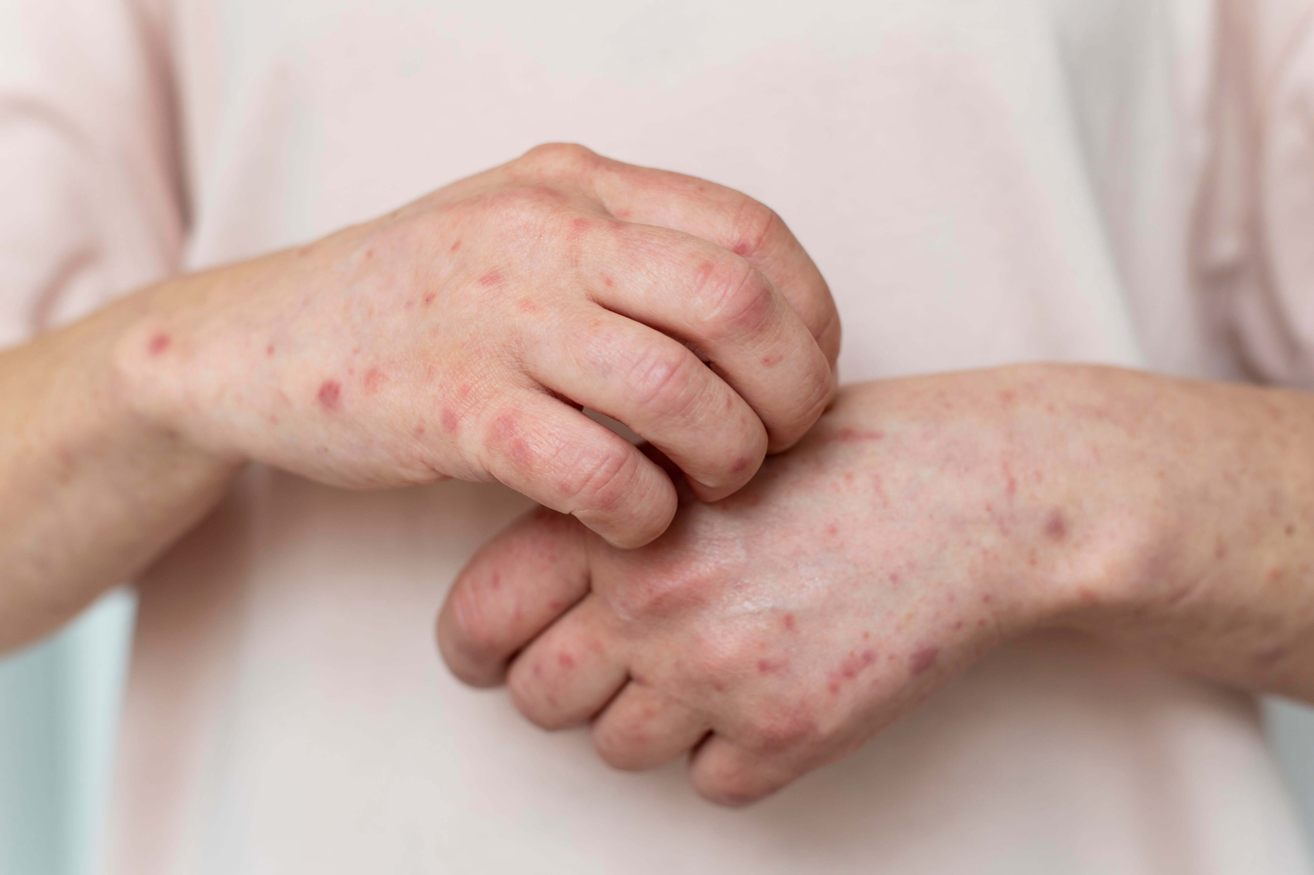 What is Monkeypox or mpox